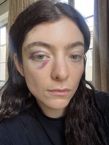 🔥 Lorde  page leaked private photo uncensored full
